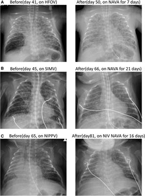 Case Report: Neurally adjusted ventilatory assist as an effective rescue treatment for pulmonary interstitial emphysema in extremely low birth weight infants